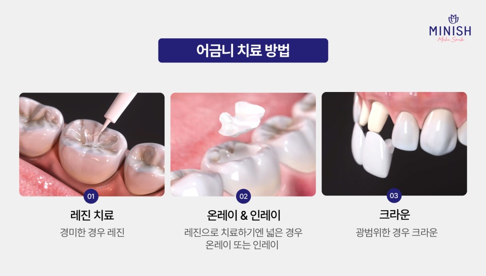 Don’t Ignore Molar Pain! Molar Minishe Can Restore Them Healthily image 4