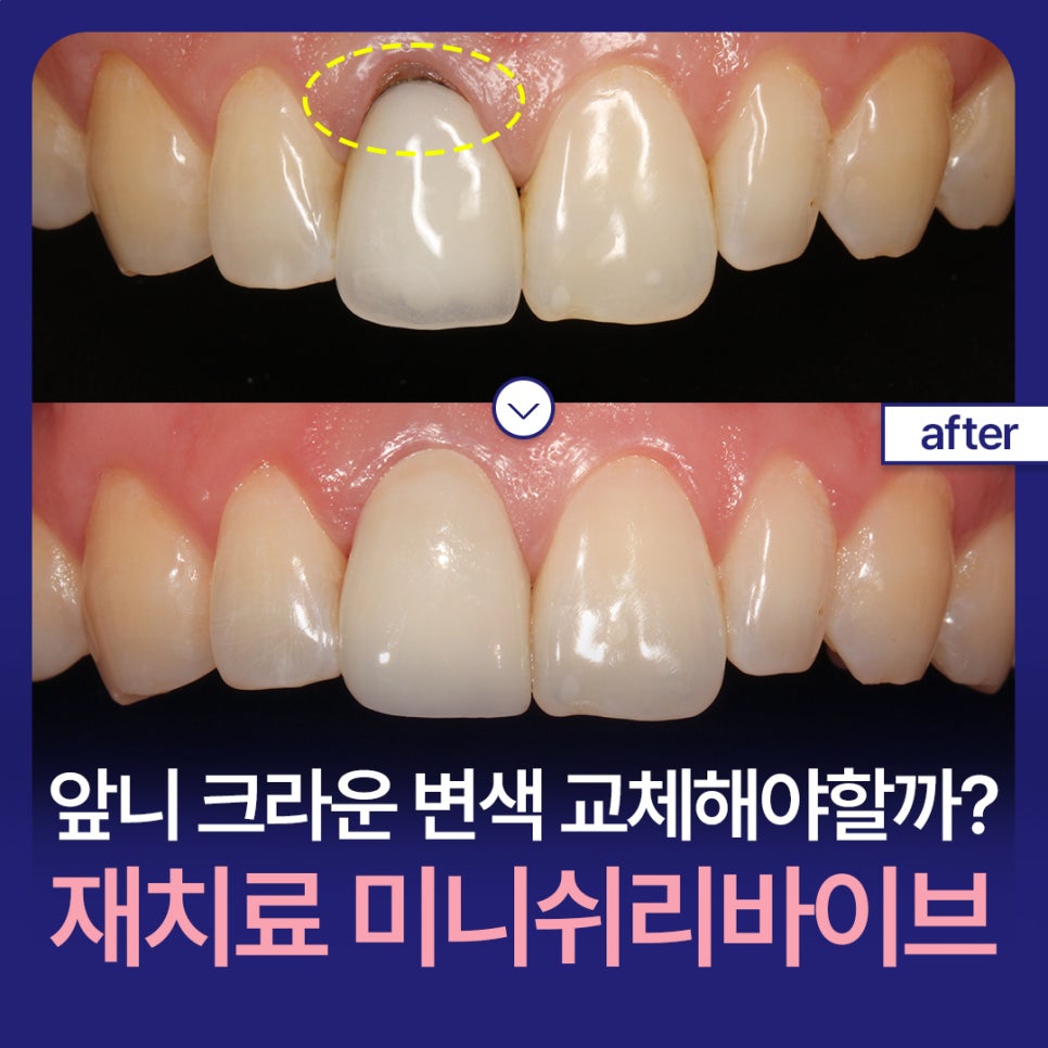Should a Discolored Front Tooth Crown Be Replaced? Minish Revive for Retreatment image 1