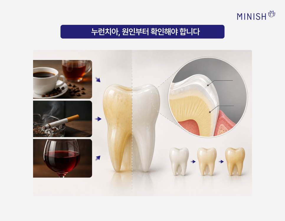 치아미백으로 해결 안 되는 누런치아, 하얗게 하려면? 관련 이미지 2