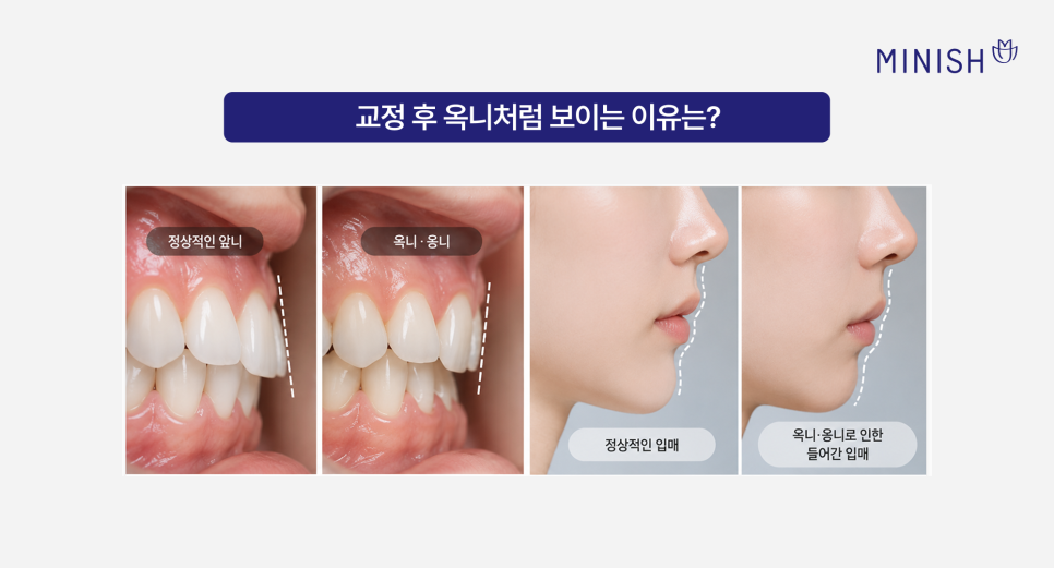 교정 후 들어간 입, 옥니 (옹니)가 고민, 미니쉬로 개선할 수 있을까? 관련 이미지 2