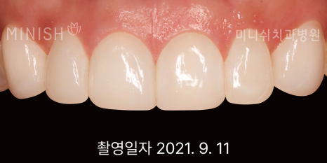 벌어진 앞니 치료 방법 세가지 장단점 관련 이미지 6