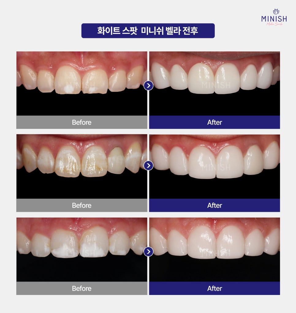 White Spots: Improve Stained Teeth Naturally with Minish! image 6