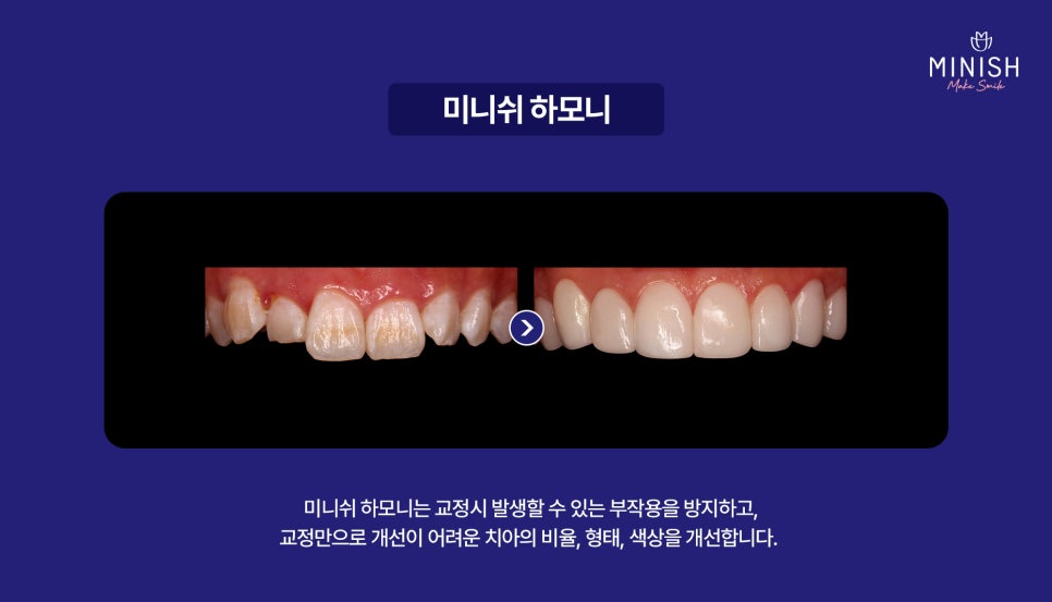 A Complete Guide to the Minish Program That Fits My Teeth image 11