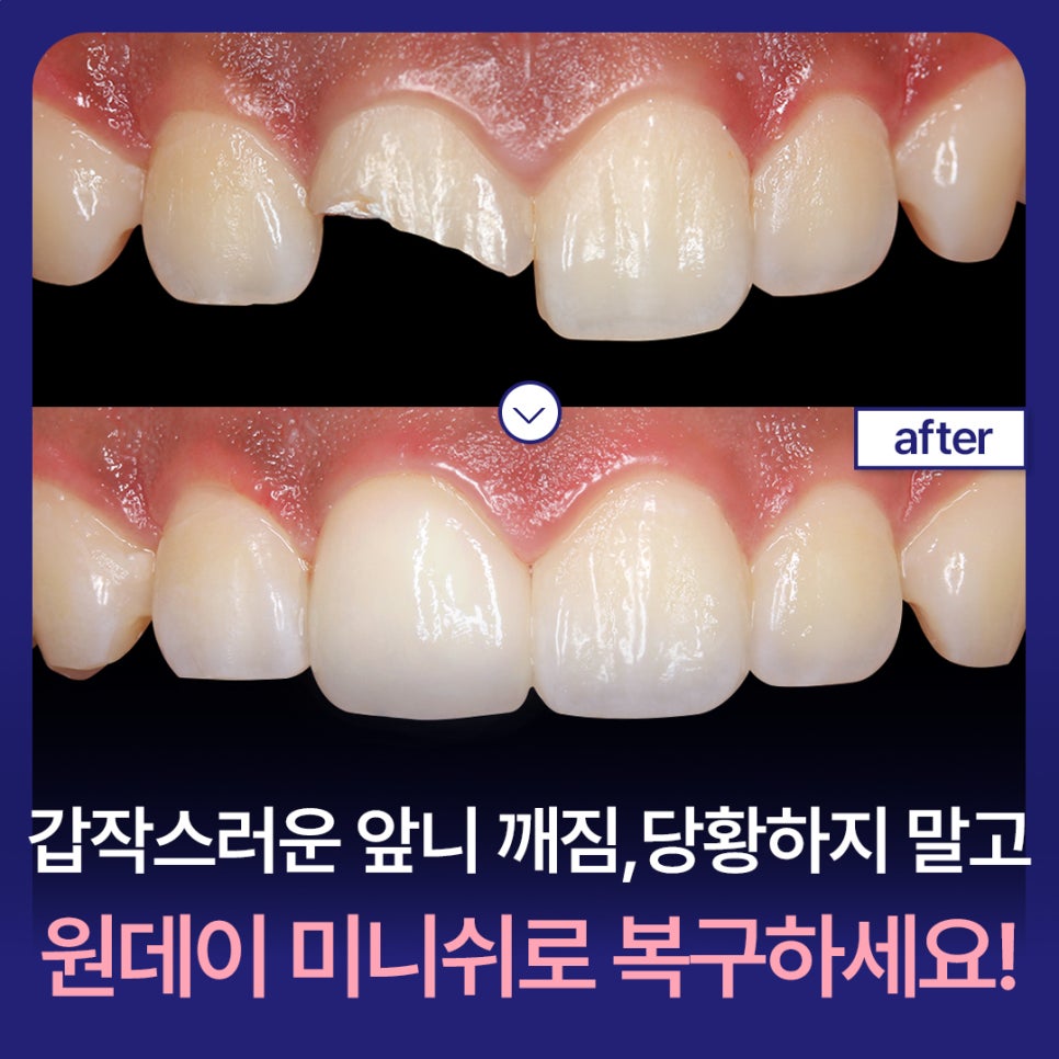Sudden Chipped Front Tooth? Don’t Panic—Restore It with One-Day Minish! image 1