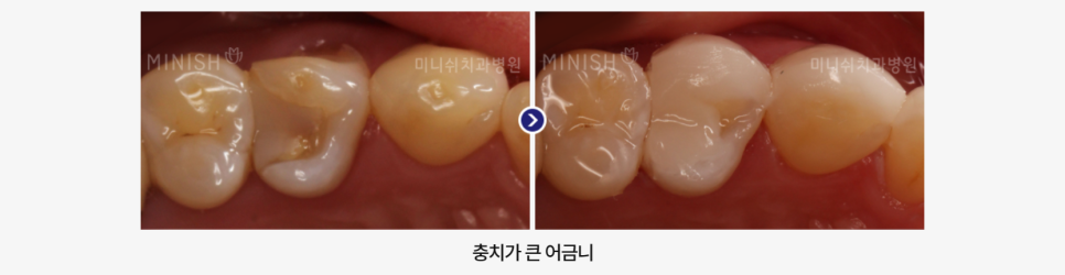 충치 근본 원인을 해결하는 미니쉬를 활용한 충치치료 관련 이미지 11