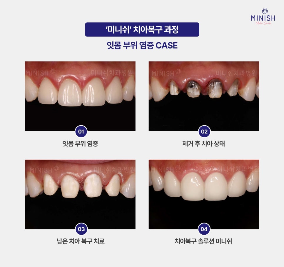 When Crown Retreatment Is Needed: The Tooth Restoration Solution Minish image 2