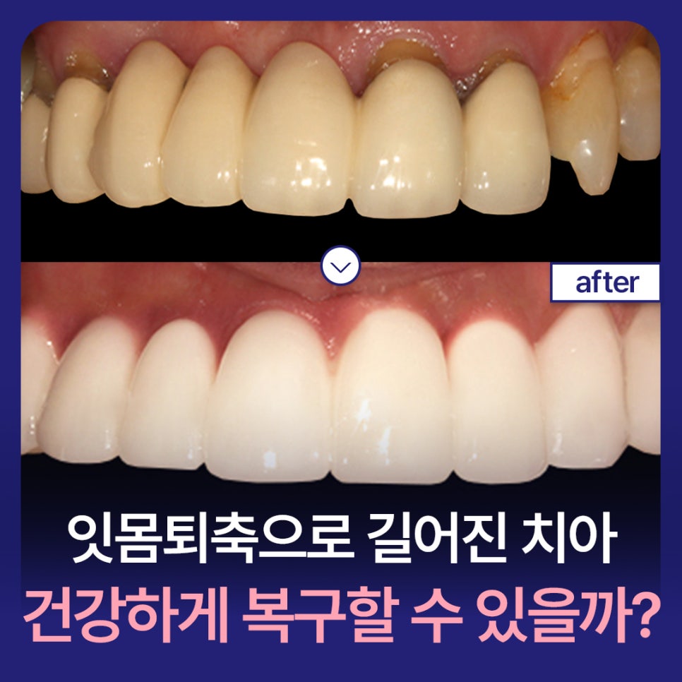 Can Teeth That Have Become Longer Due to Gum Recession Be Restored Healthily? image 1