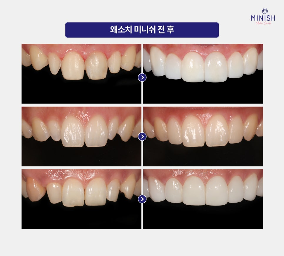 작은 치아, 왜소치 고민이라면? 하루 만에 개선할 수 있습니다 관련 이미지 5