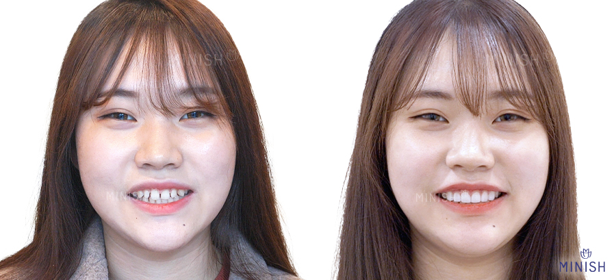 치아성형 고민? 미니쉬치과 병원에서 해결! 관련 이미지 2