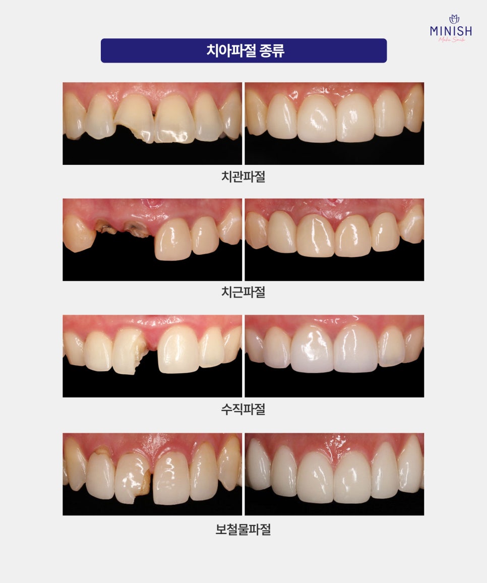 Hakdong Station Dental Clinic: Broken Teeth and Tooth Fracture Treatment — How Long Is the Golden Time? image 2