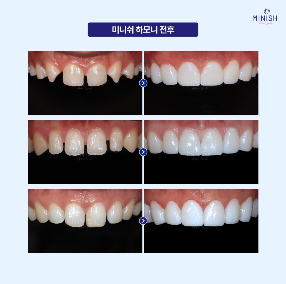 How to Restore Gapped Teeth Healthily in Just One Day image 5