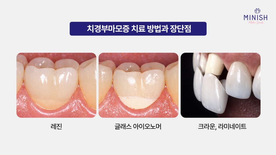 What Causes Tooth Notching? Symptoms and Treatment of Cervical Abrasion image 5