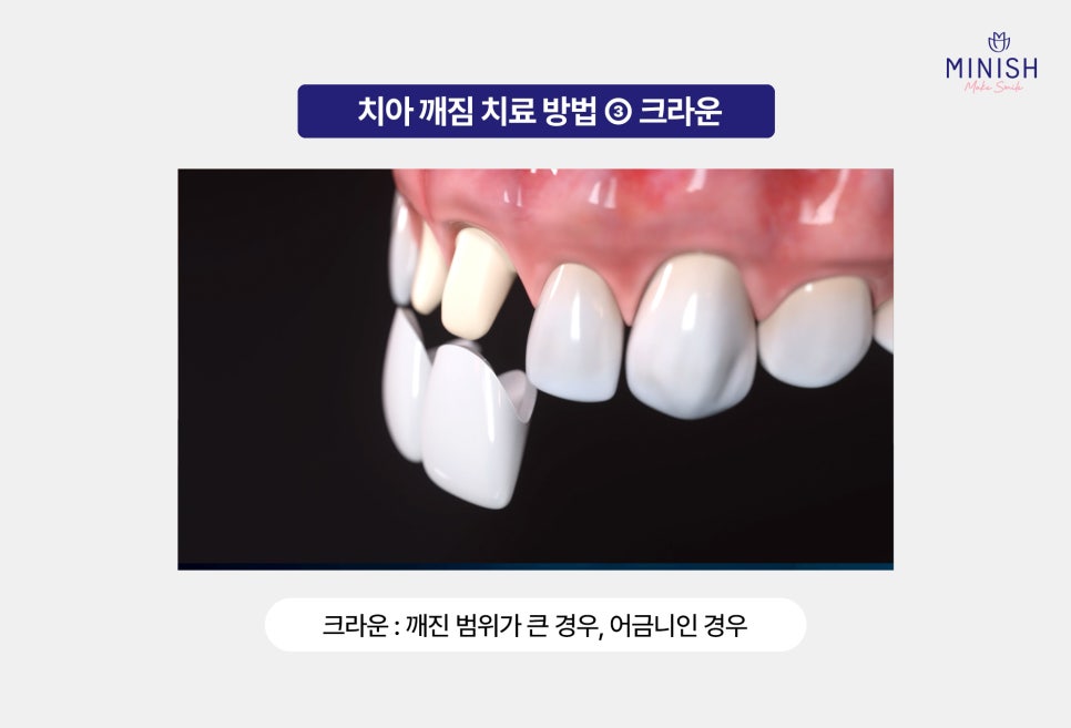 A Chipped Tooth: Which Treatment Should You Choose? A Comparison of Pros and Cons image 4
