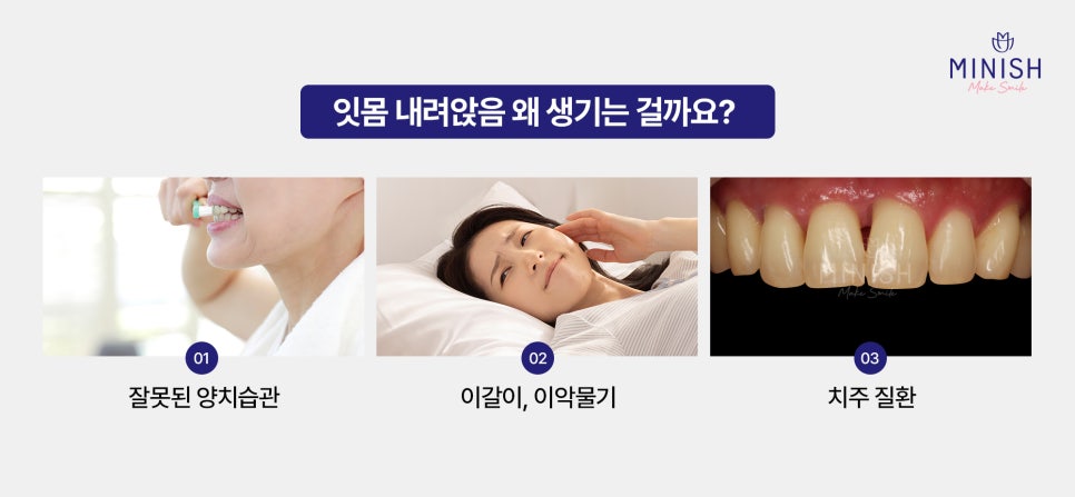 Worried About Gum Recession? Symptoms by Stage and Ways to Improve It image 2