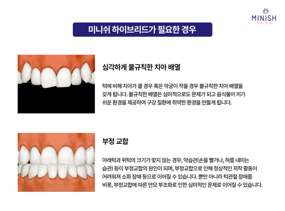 A Complete Guide to the Minish Program That Fits My Teeth image 9