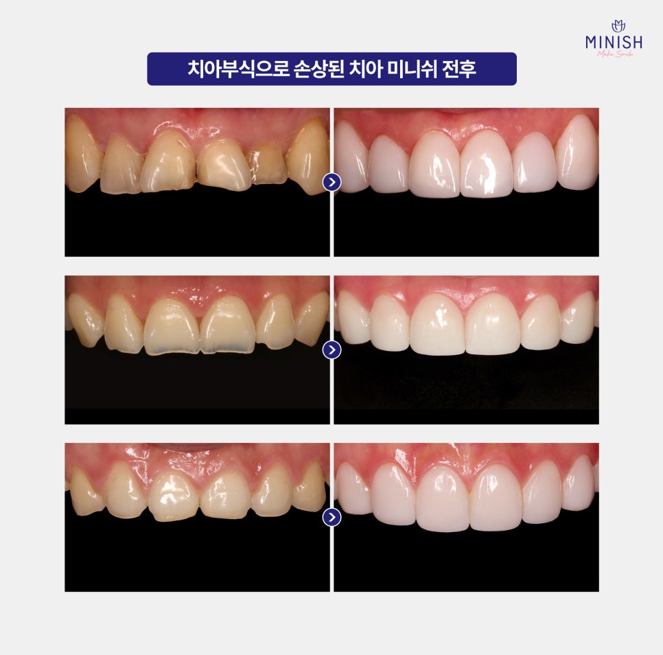 Why Teeth Wear Down Over Time: Causes of Tooth Erosion and How to Address It image 5