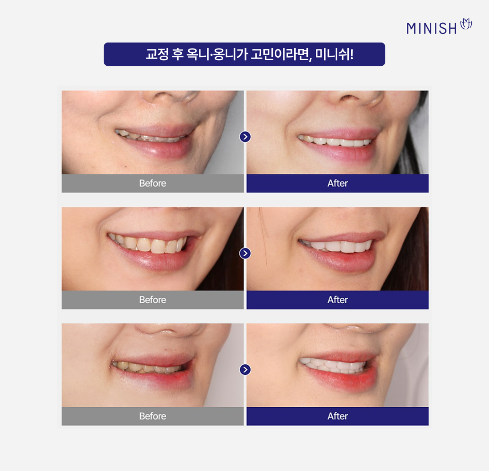 교정 후 들어간 입, 옥니 (옹니)가 고민, 미니쉬로 개선할 수 있을까? 관련 이미지 6