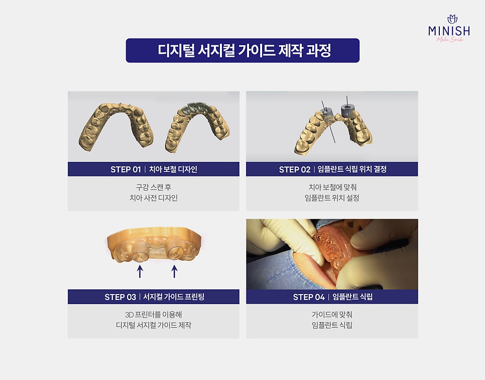 Implants, Only When Truly Necessary! Minish Dental Hospital’s Treatment Process for Protecting Natural Teeth image 5