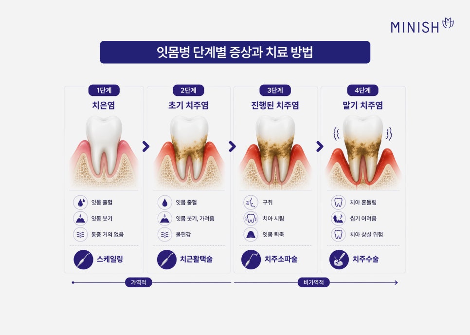 치석 제거 안 하면? 잇몸병 단계별 증상 및 치료 방법 관련 이미지 5