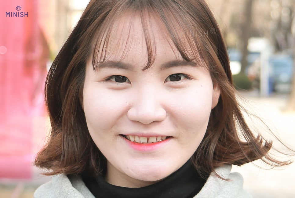 벌어진치아 교정은 미니쉬 잘하는 곳에서 미니쉬! 관련 이미지 2