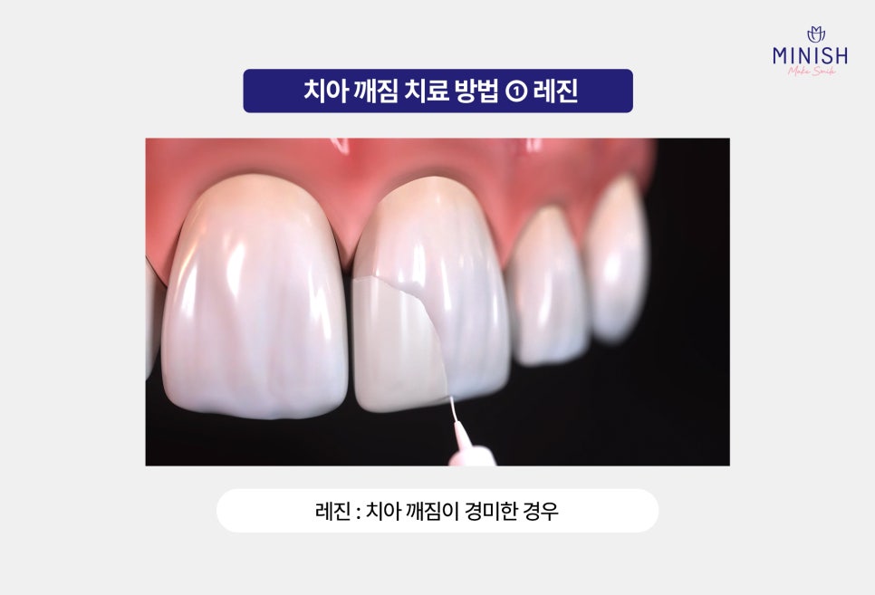 A Chipped Tooth: Which Treatment Should You Choose? A Comparison of Pros and Cons image 2