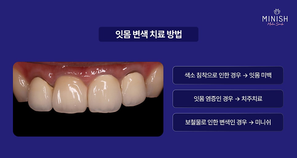 Have your gums turned dark? What causes gum discoloration, and how can it be improved? image 3
