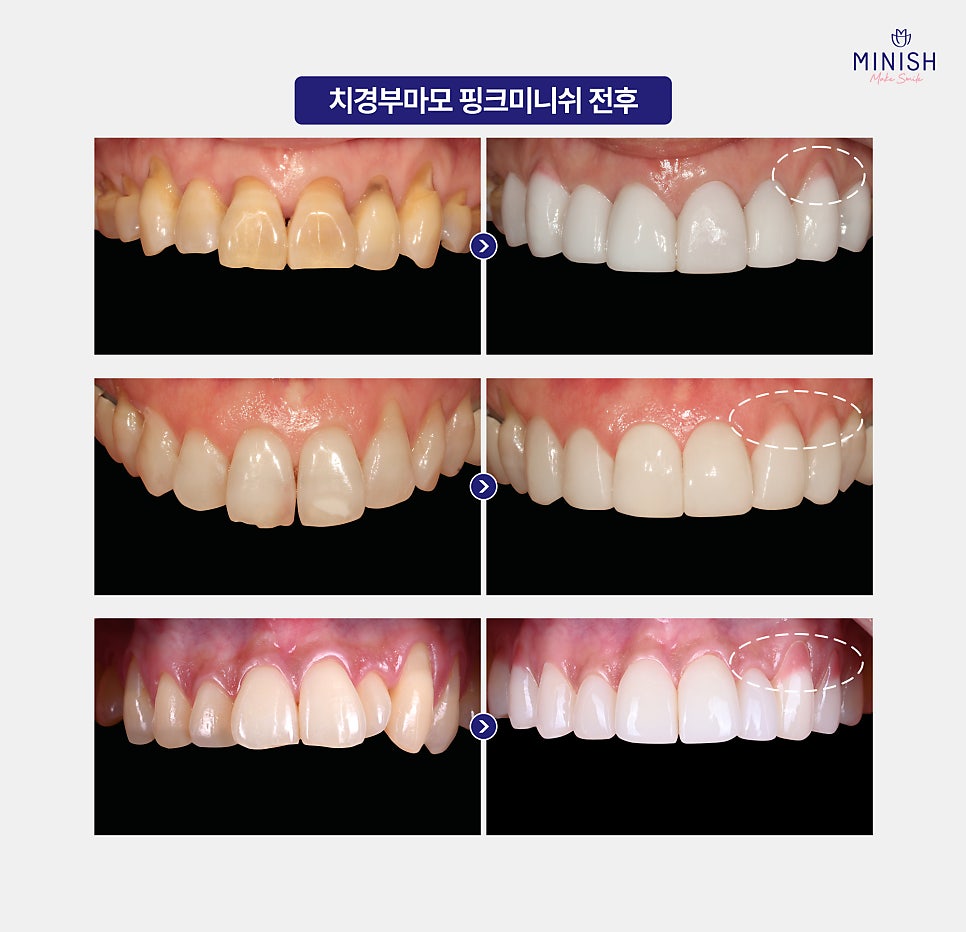 Relieve Tooth Sensitivity Caused by Cervical Abrasion with Pink Minishe image 7