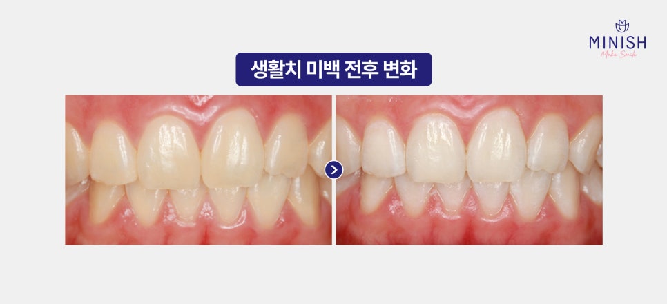 Yellow Teeth Concerns: Teeth Whitening Methods That Vary by Cause image 8