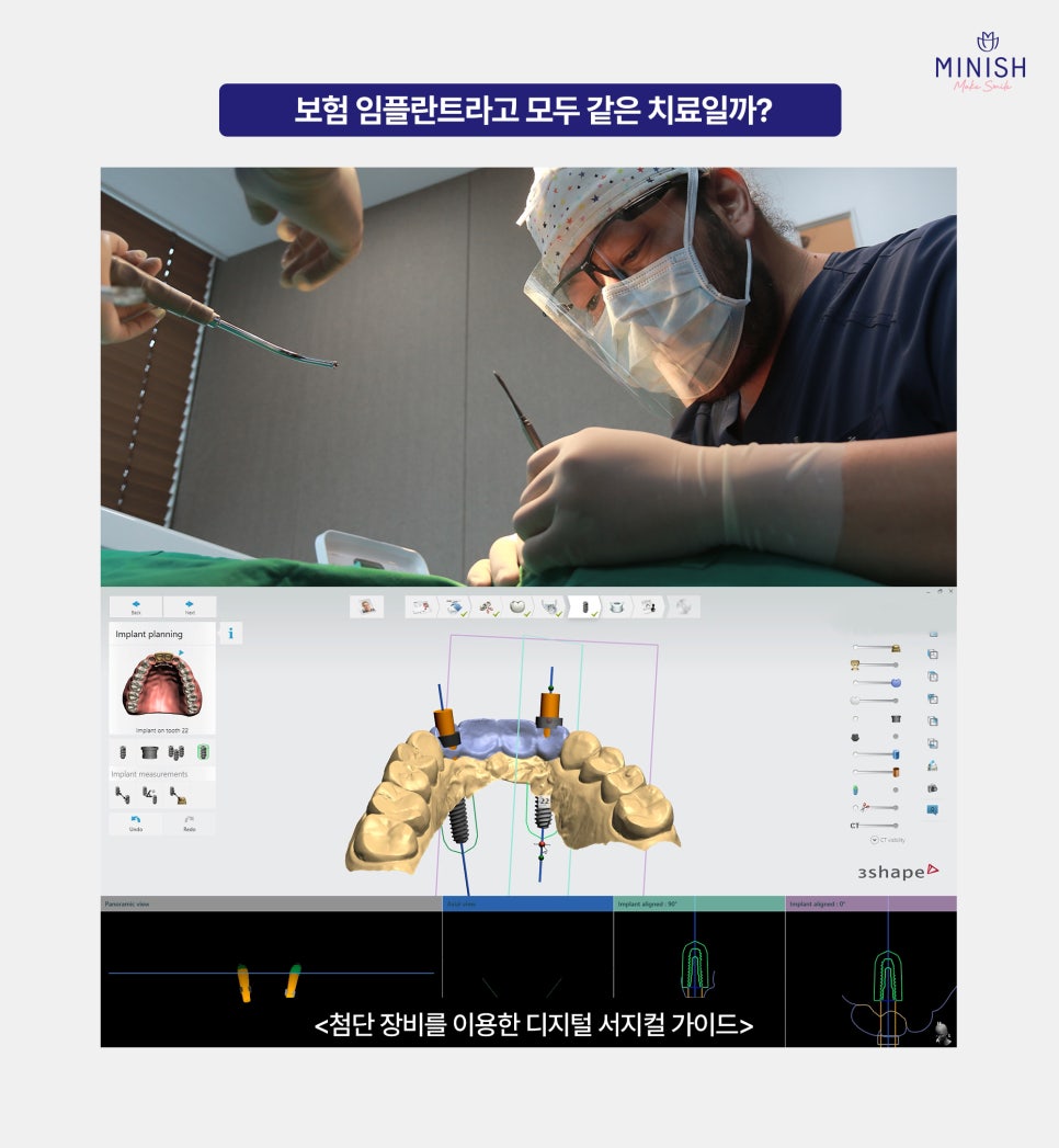65세이상 임플란트 보험 적용 나이 기준과 주의사항 알아보기 관련 이미지 4