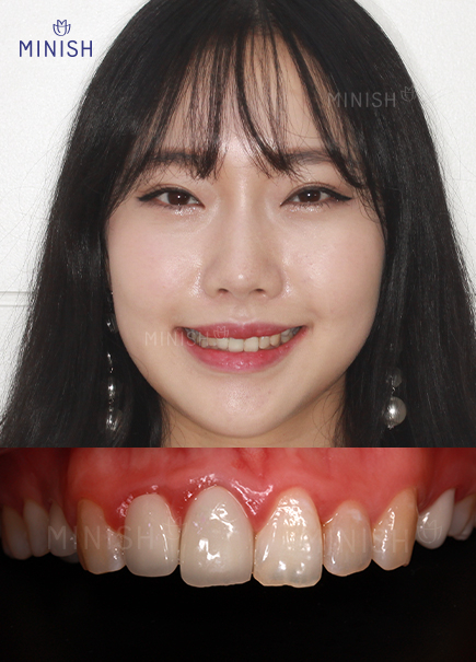 통증 부르는 부은 잇몸 멈춰! 건강한 미니쉬로 해결하세요 관련 이미지 3
