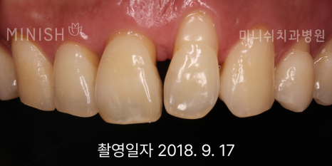 잇몸 내려앉음, 잇몸퇴축 원인과 치료 방법은? 관련 이미지 9