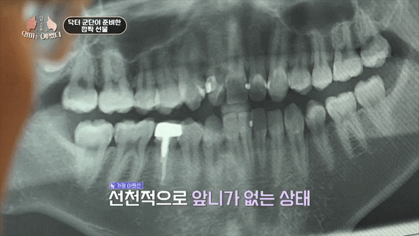 두 개여야 할 앞니가 한 개라면? [엄마는예뻤다 가평아들편] 관련 이미지 3