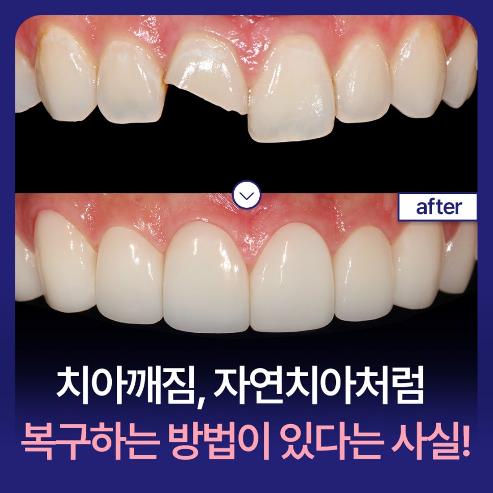A chipped tooth: the fact that there is a way to restore it like a natural tooth! image 1