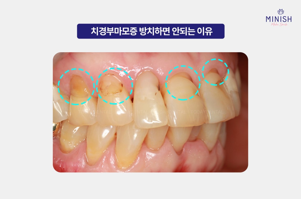 Relieve Tooth Sensitivity Caused by Cervical Abrasion with Pink Minishe image 4