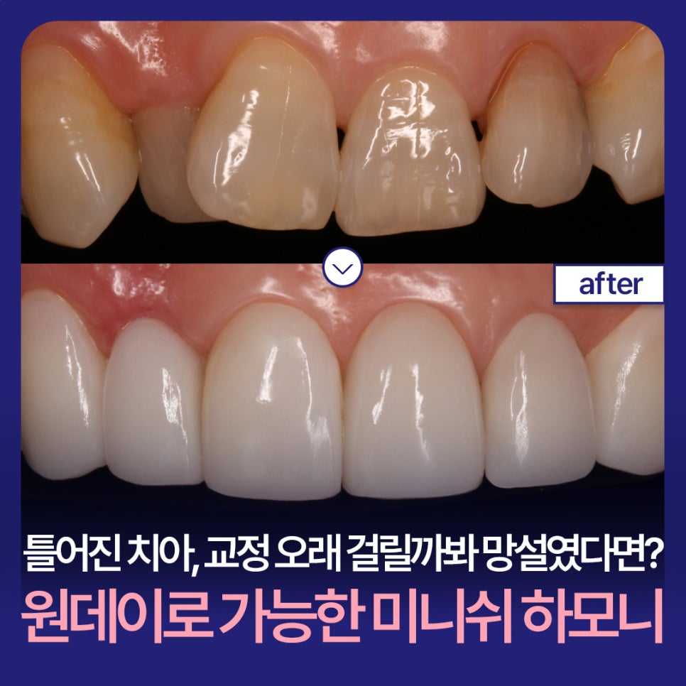 Crooked Teeth—Hesitating Because Orthodontic Treatment Might Take Too Long? Minish Harmony, Available in One Day image 1