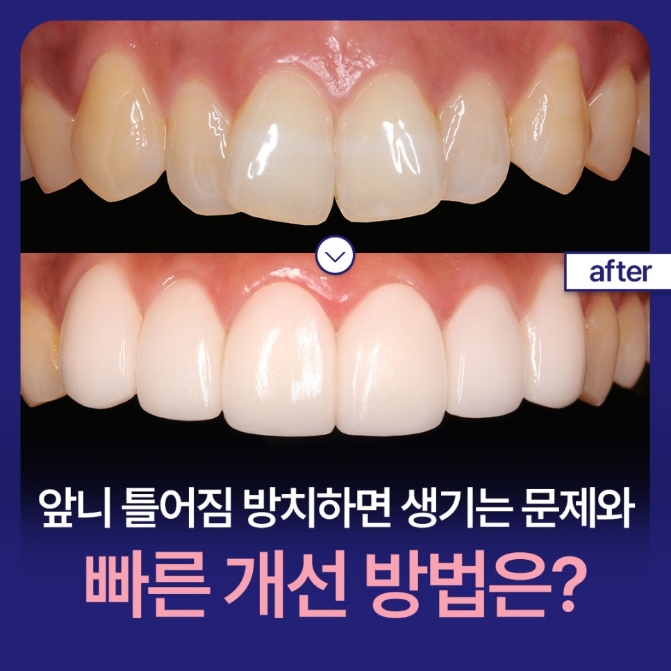 What Problems Can Crooked Front Teeth Cause If Left Untreated, and What Are the Fast Ways to Improve Them? image 1