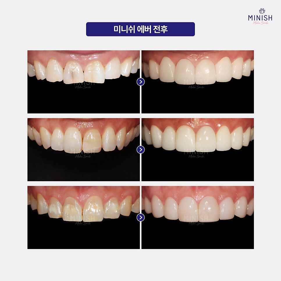 How Can Cracked Teeth Be Repaired Quickly and Healthily? A Complete Guide to Treatment Options image 5