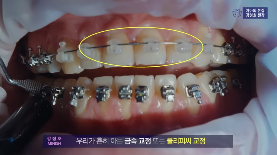 치아교정 앞둔 당신이 반드시 알아야 할 점① - 인비절라인 편 관련 이미지 3