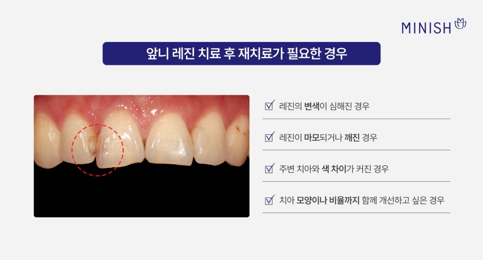 Understanding Discolored Resin on Front Teeth, from Causes to Retreatment image 4