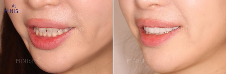 취업 방해하는 앞니덧니! 신사역치과에서 미니쉬로 해결 관련 이미지 6