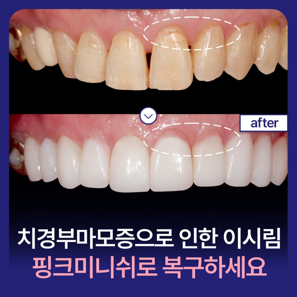 Relieve Tooth Sensitivity Caused by Cervical Abrasion with Pink Minishe image 1