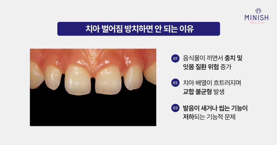치아 벌어짐 왜 생길까요? 원인부터 치료 방법까지 관련 이미지 3