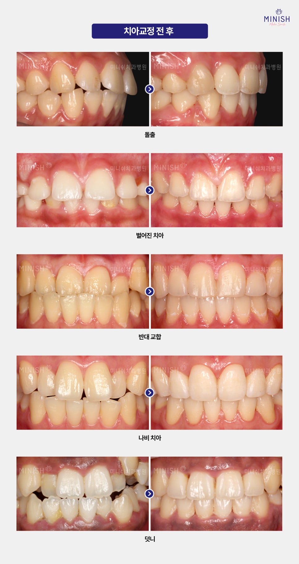 Types of Orthodontic Treatment at Minish Dental Hospital and How to Improve Aesthetics Too! image 5