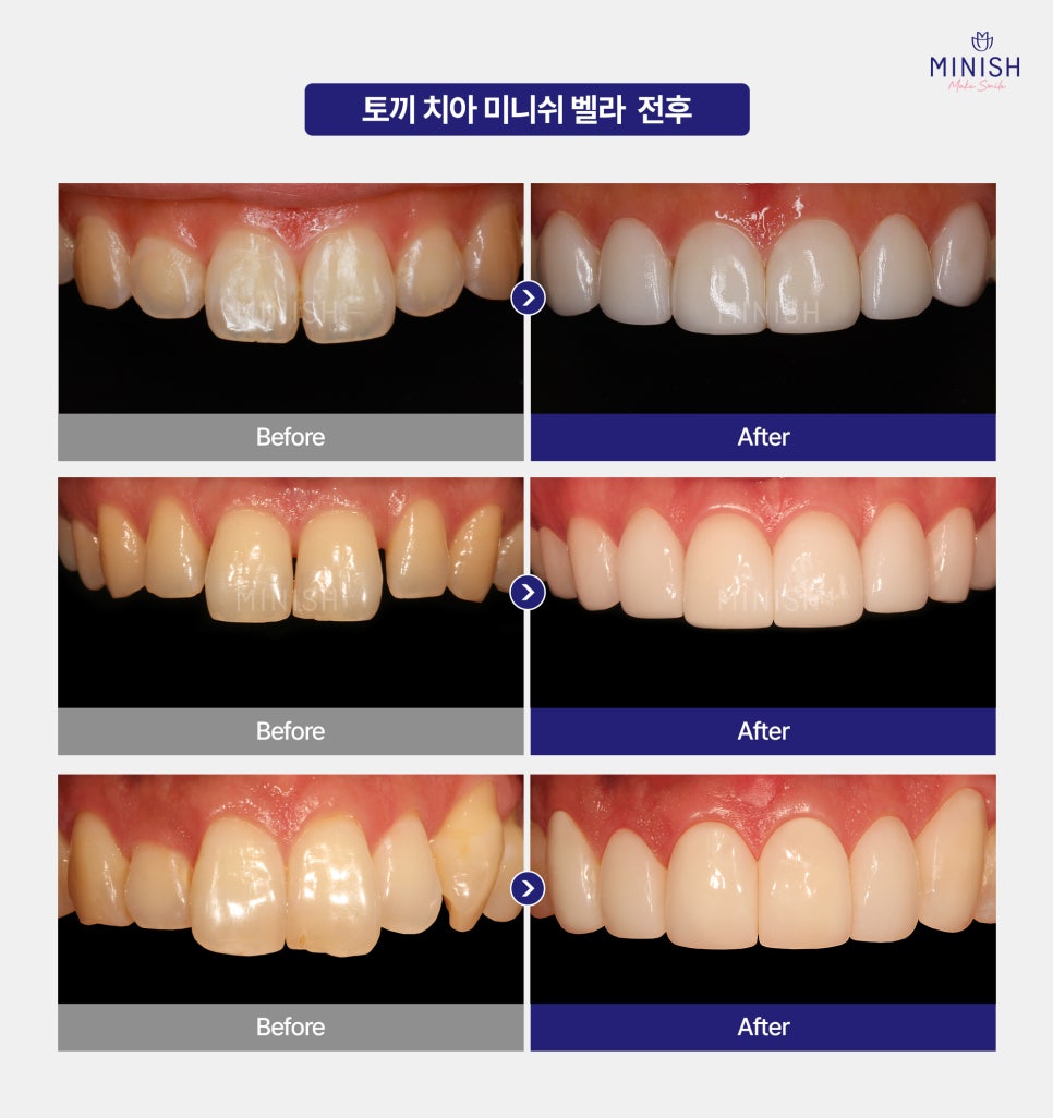 Prominent Rabbit Teeth: Change to a Healthier Smile in Just One Day with Minish image 5