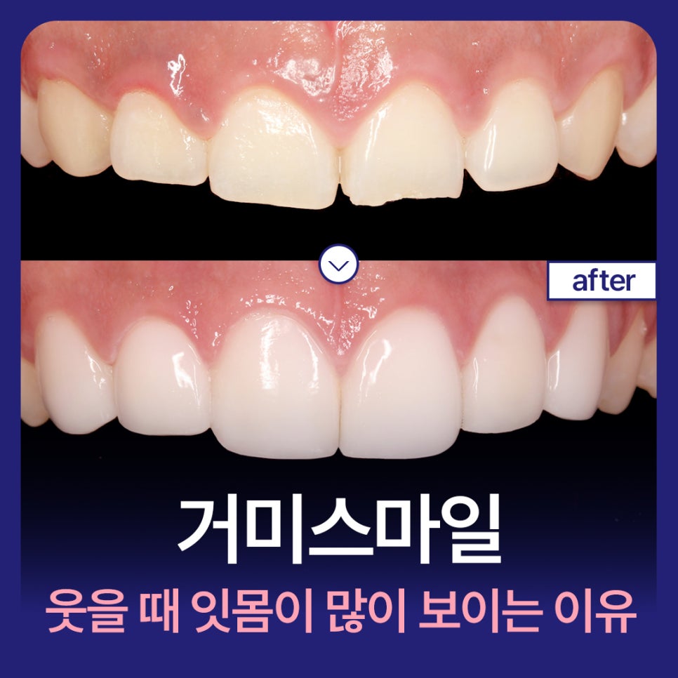 Gummy Smile: Why the Gums Show So Much When You Smile and How to Improve It image 1