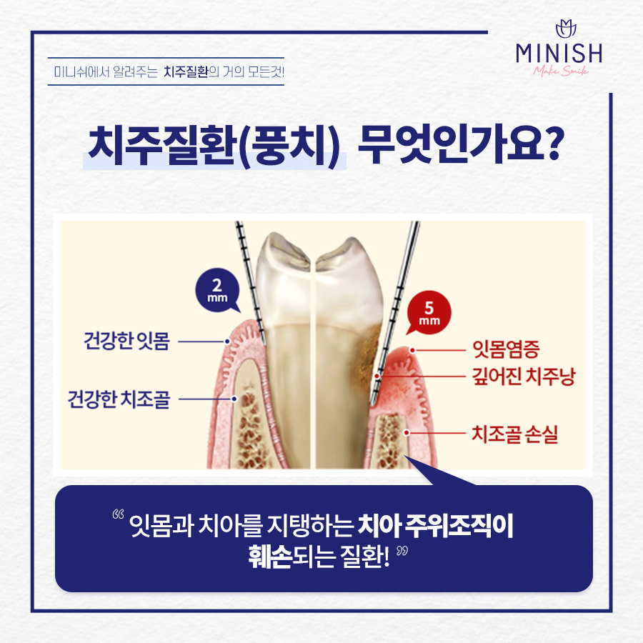'치주질환'의 거의 모든 것 +잇몸/풍치 자가 체크 관련 이미지 3