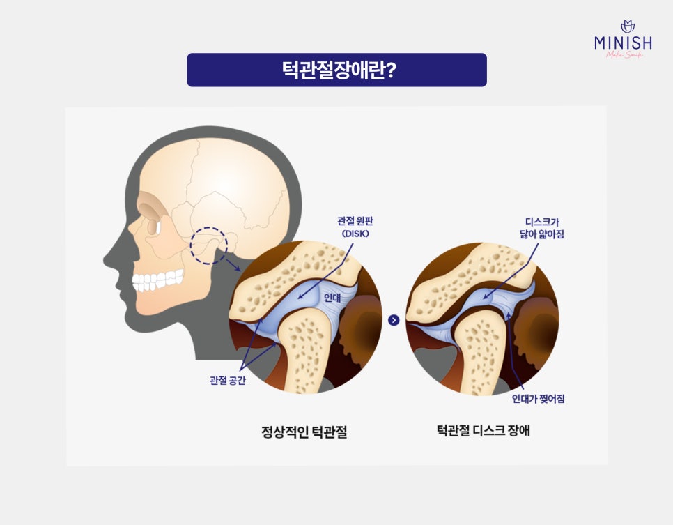 A clicking sound in the jaw? Temporomandibular joint disorders should not be left untreated image 2