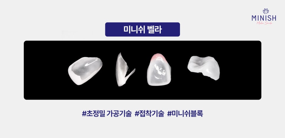 White Spots on Teeth: Worried About White Stains on Your Teeth? Here’s How to Improve Them Healthily! image 5
