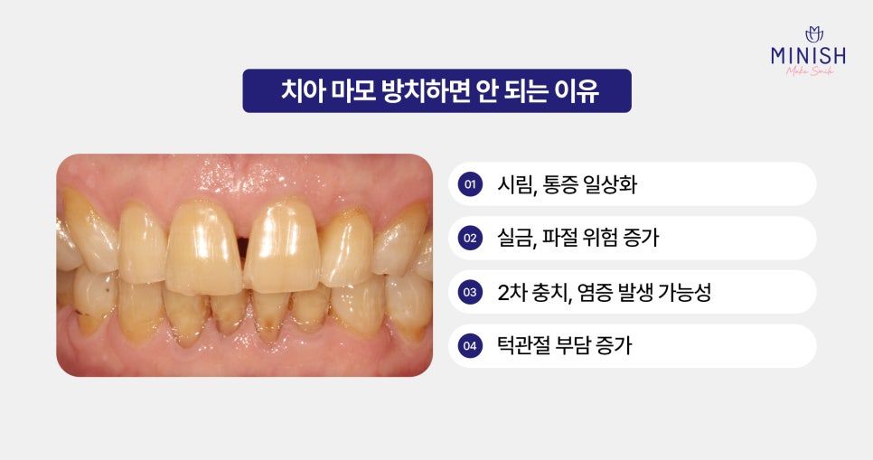 Pain Caused by Tooth Wear: From the Root Causes to Recovery Methods image 4