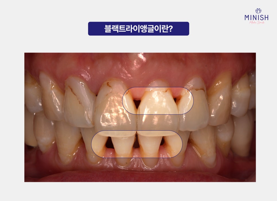 Black Triangles Between Teeth: What Causes Black Triangles and How Can They Be Resolved? image 2
